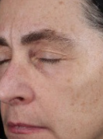 Day 1 of a second woman before application of Miracle Set.